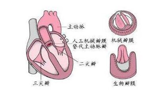 三尖瓣狭窄