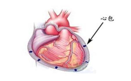 缩窄性心包炎
