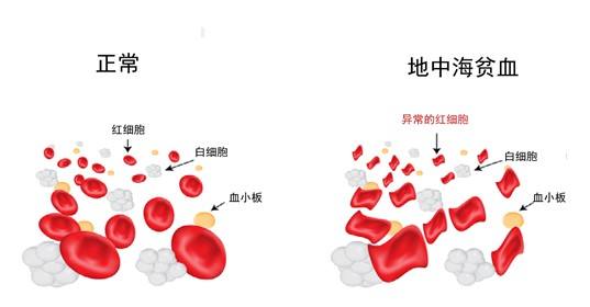 地中海贫血