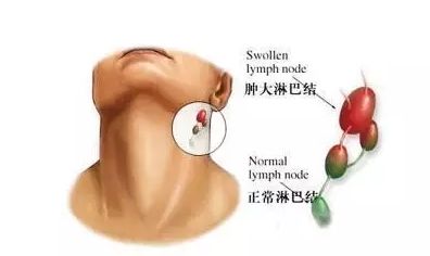 慢性淋巴结炎