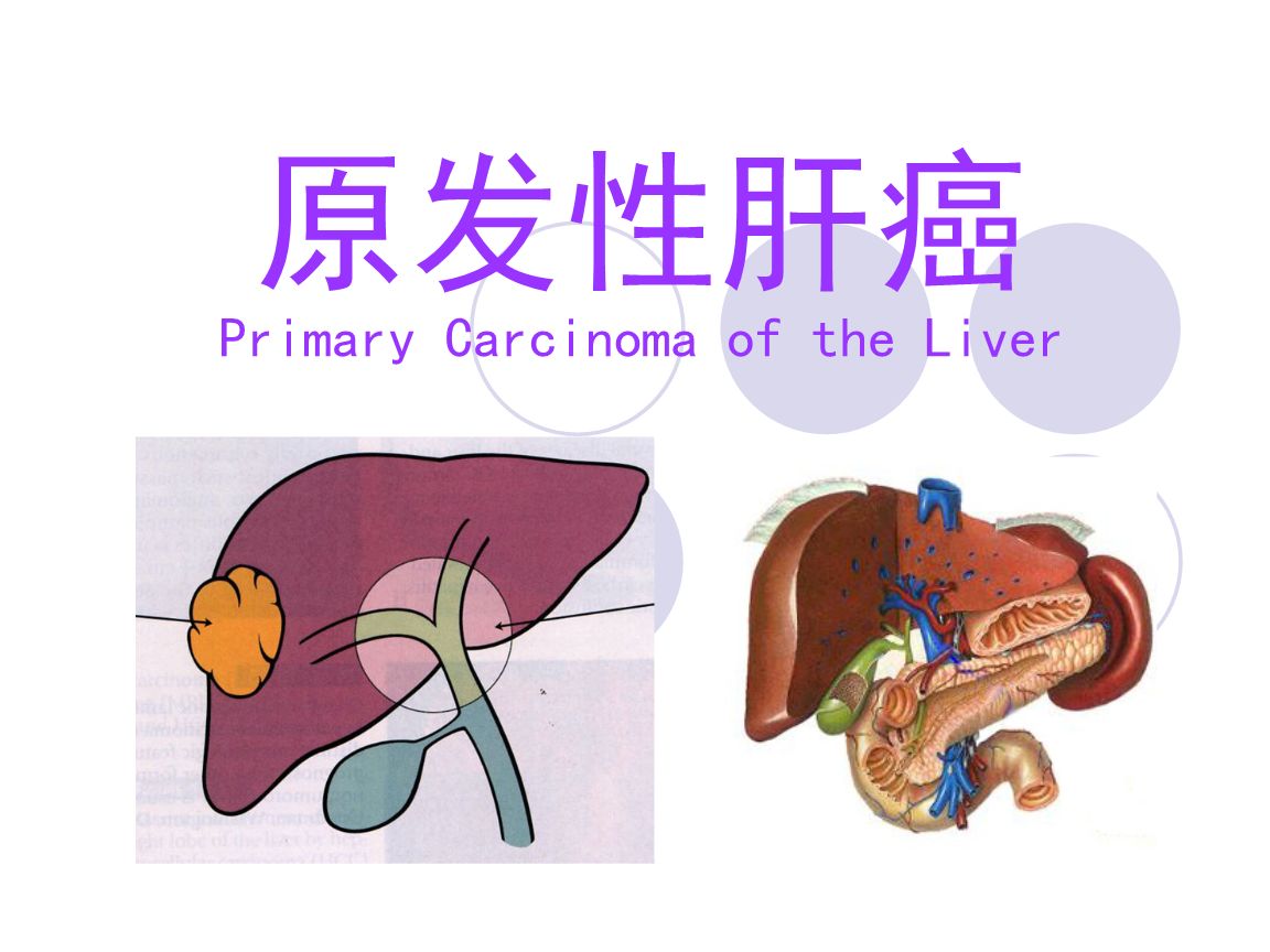 原发性肝癌