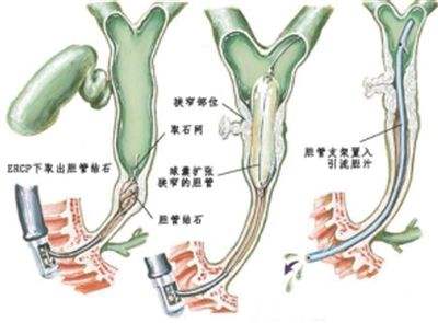 胆管炎