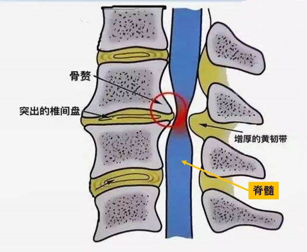 脊髓型颈椎病