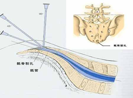 骶管囊肿