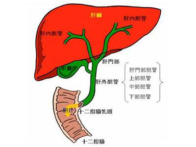 肝外胆管结石