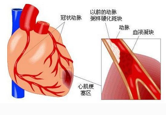 急性心肌梗死