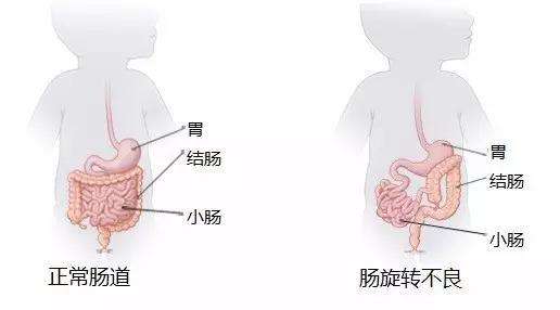 先天性肠狭窄