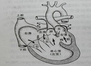 单心室