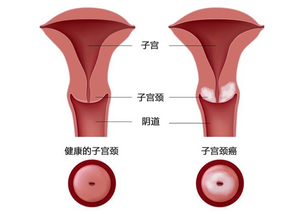 宫颈癌前病变