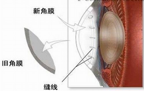 角膜移植