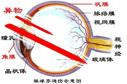 眼球穿通伤