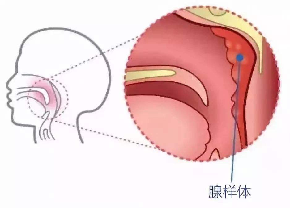 腺样体炎