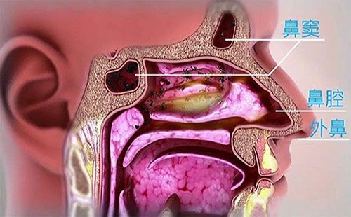 鼻腔及鼻窦异物