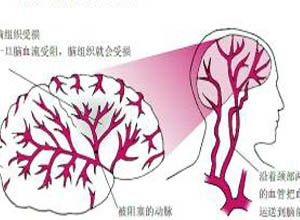 眼缺血综合征